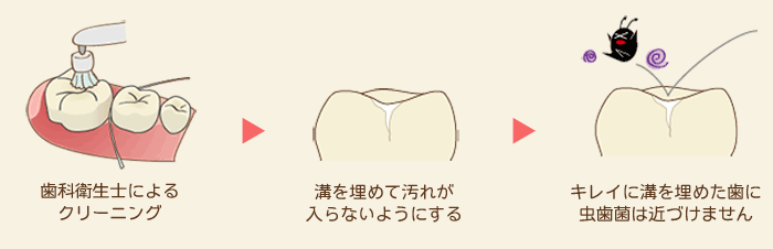 シーラント